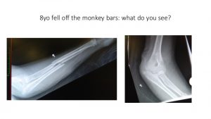 Monkey bar fall