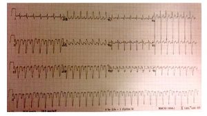 EKG 1