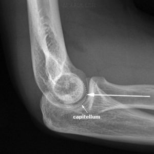lateral elbow - wikiradiography.net