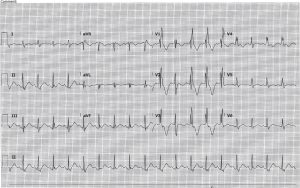 cardiac-contusion