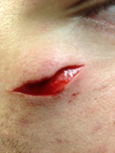 facial laceration