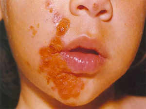 Impetigo