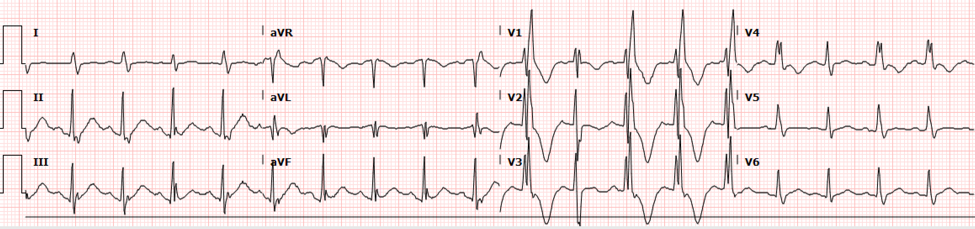 ECG 3 | PEM Source